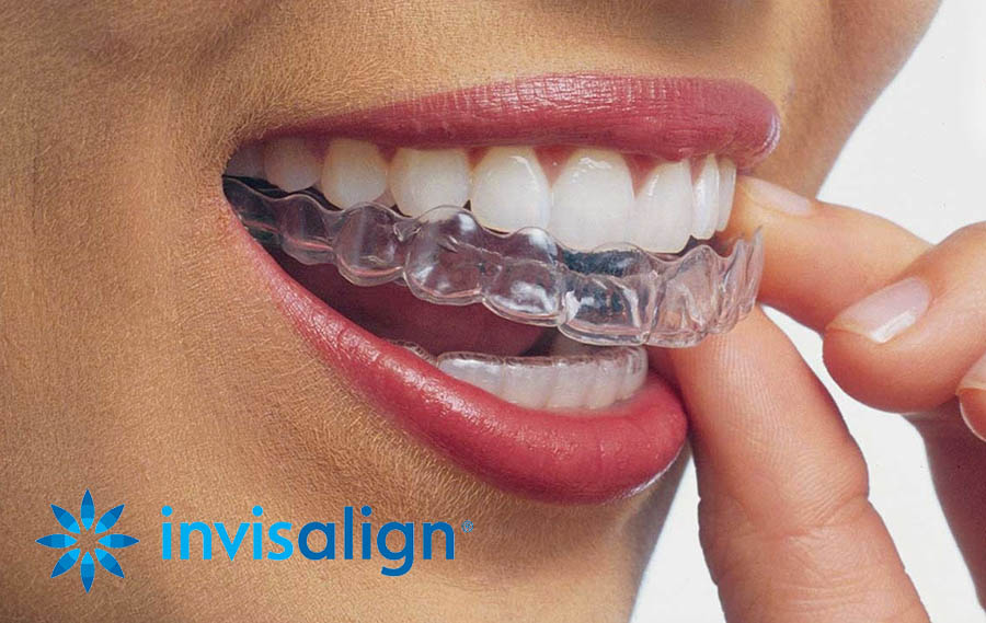 Invisalign (Clear Braces) - Arcadia Family and Cosmetic